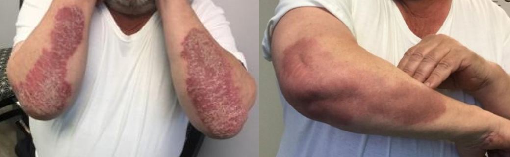 How is the Xtrac Psoriasis Treatment Performed?