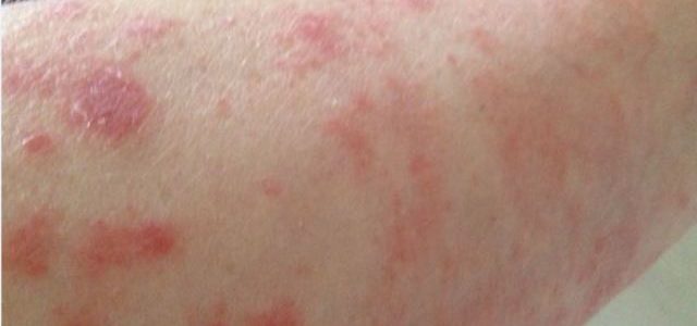 How Long Does A Flare Up Of Psoriasis Last