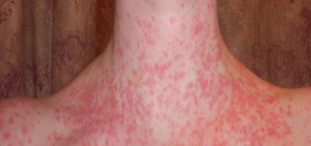 How Long Does A Guttate Psoriasis Flare Up Last
