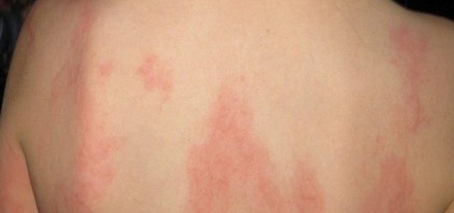 How Long Does Eczema Take To Clear Up