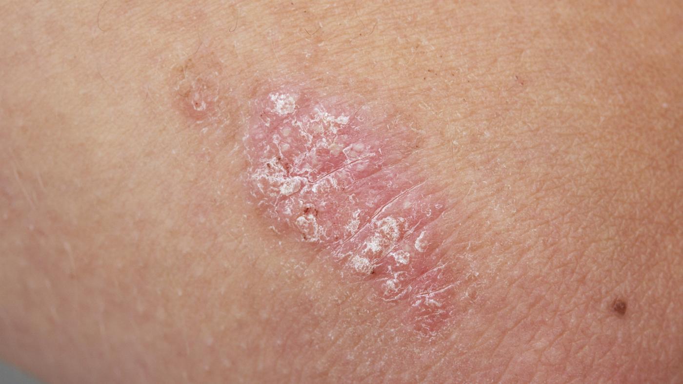 How Long Does Guttate Psoriasis Last?