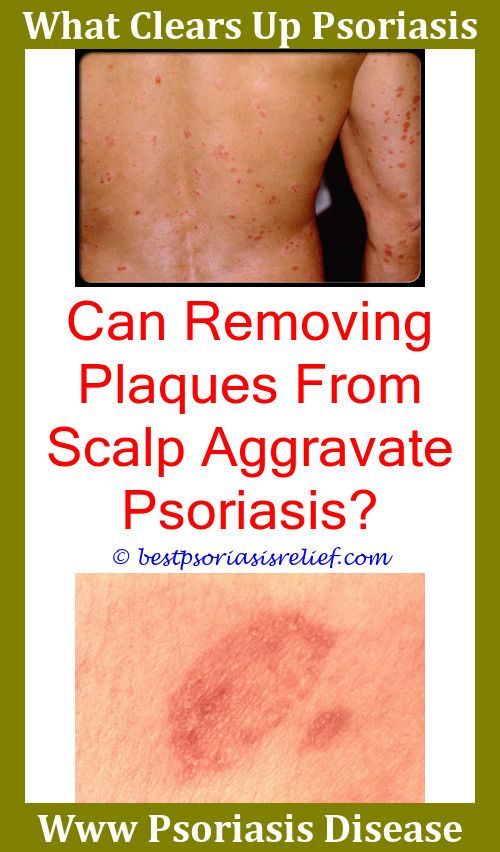 How Long Does It Take For Guttate Psoriasis To Heal ...