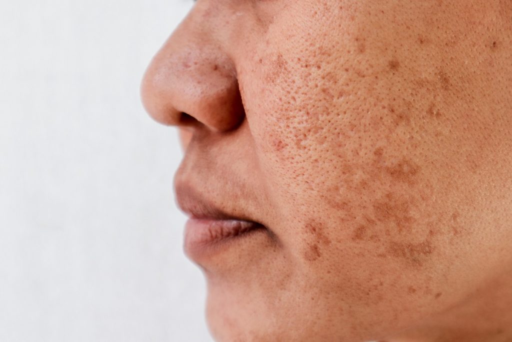 How Much Does Melasma Treatment Cost?