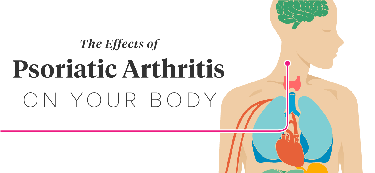 How Psoriatic Arthritis Affects the Body