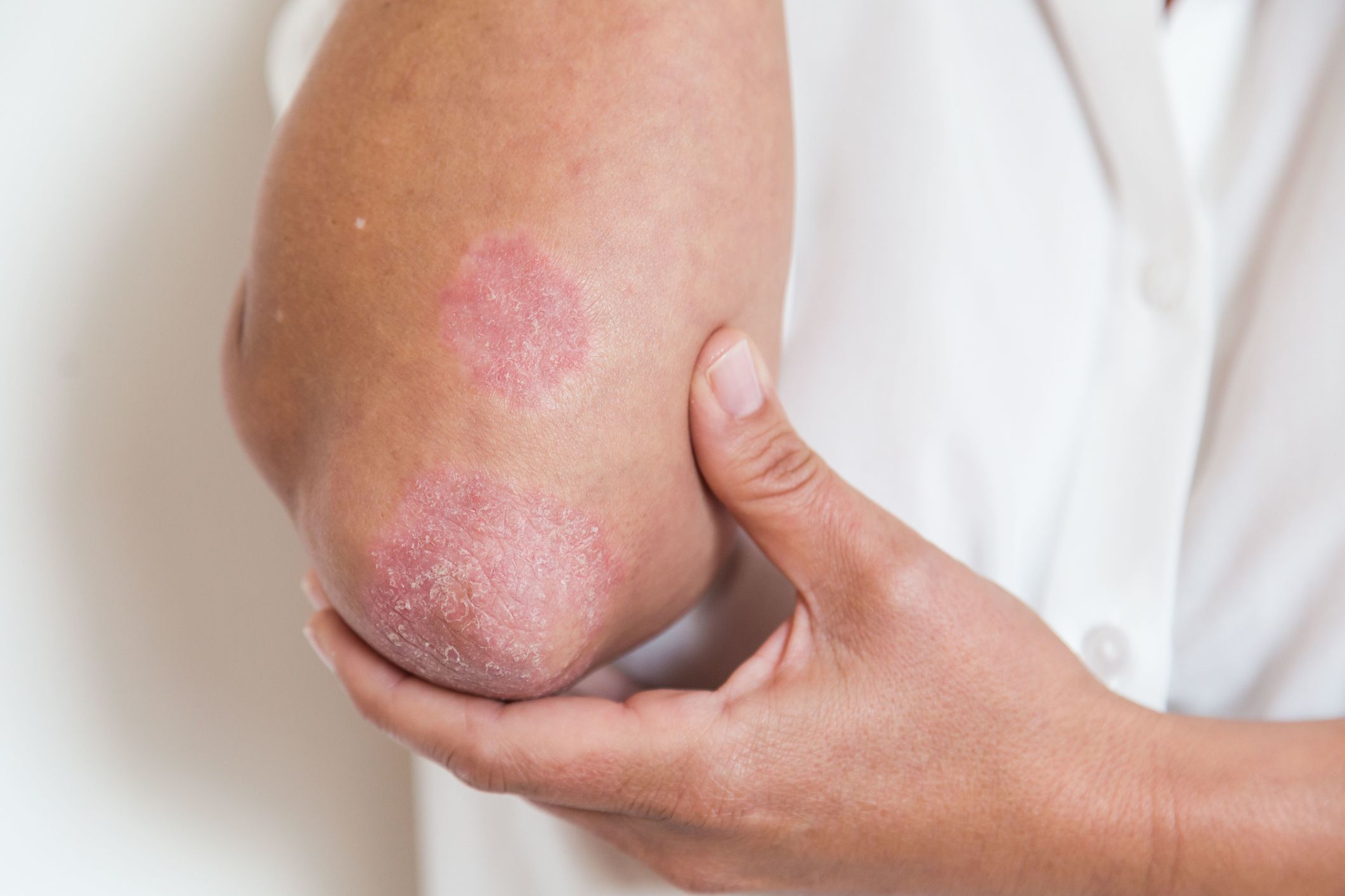 How Psoriatic Arthritis Affects the Skin