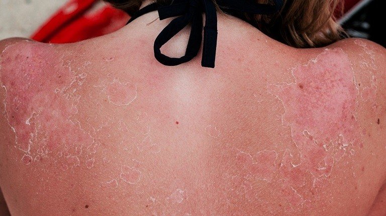 How Sun Affects Skin