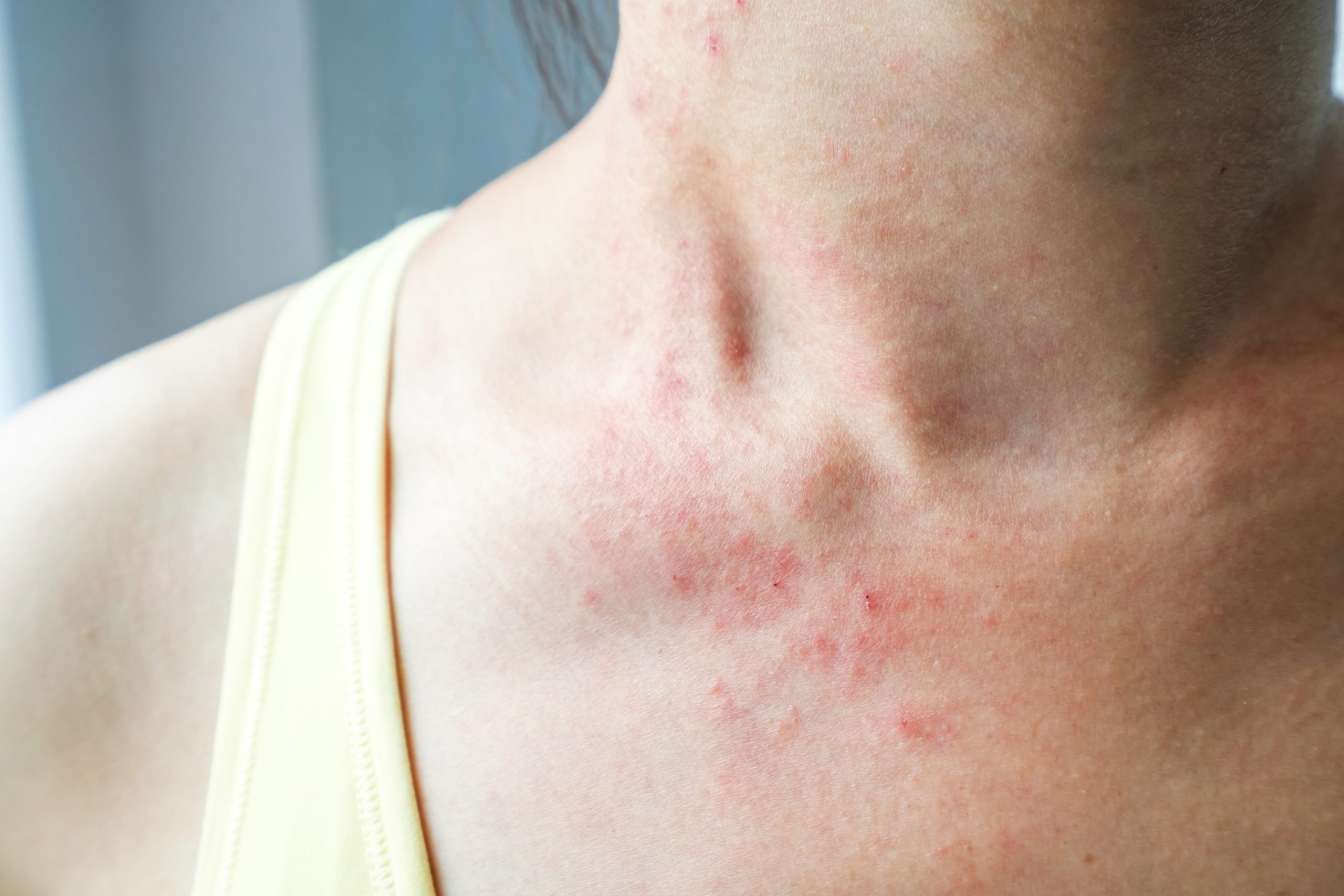 How tell if your rash is contact dermatitis, eczema ...