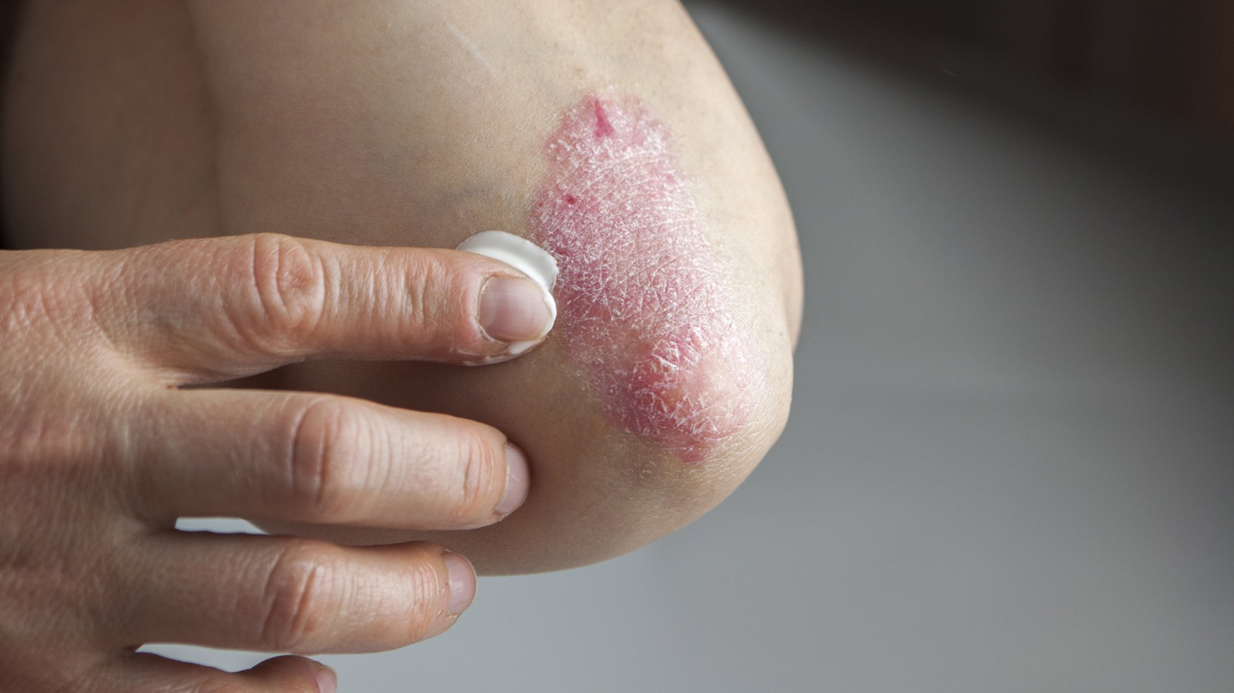 How the skin disease psoriasis costs us billions