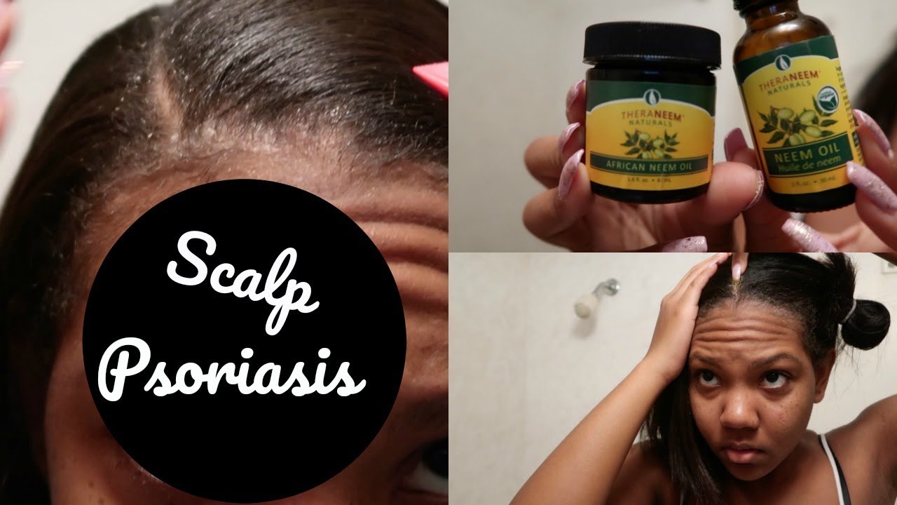 How To Apply Neem Oil for Scalp Psoriasis