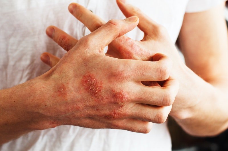 How To Calm A Psoriasis Flare
