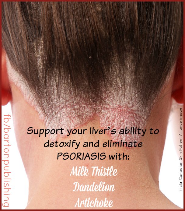 How to Cleanse the Liver to Eliminate Psoriasis