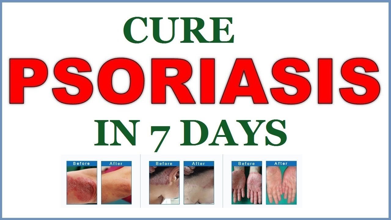How To Cure Psoriasis Naturally And Effectively With THIS ...