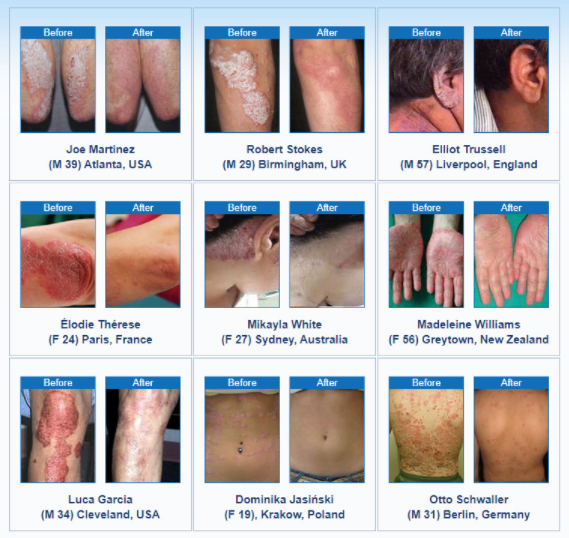 How To Cure Psoriasis Permanently: 10 Success Story And Remedies To Try