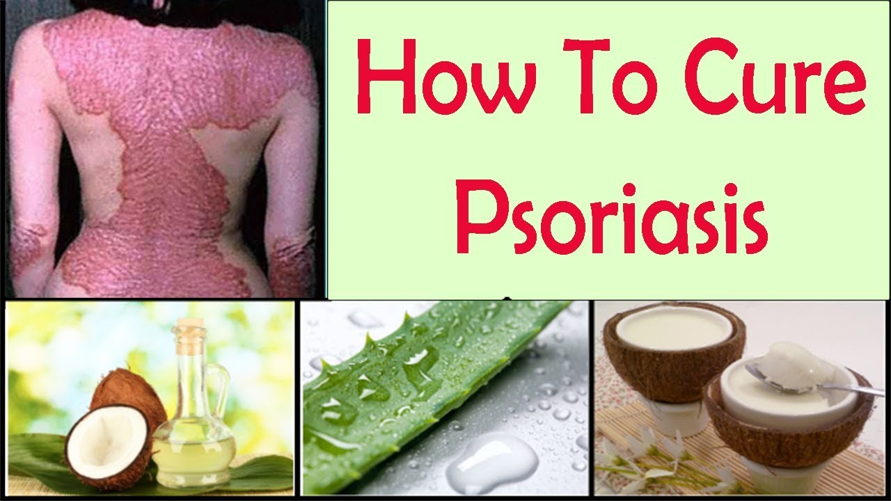 How To Cure Psoriasis Permanently With Natural Home Remedies