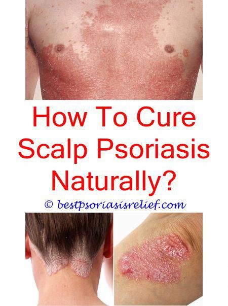 How To Cure Scalp Psoriasis Permanently In Tamil