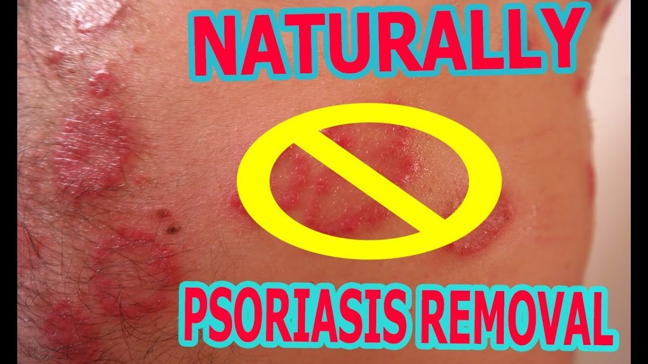 How To Cure treat Psoriasis Naturally Permanently