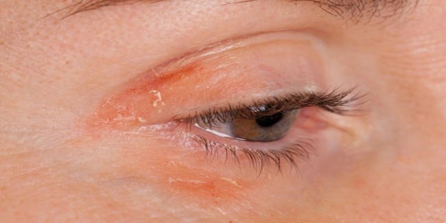 How to deal with psoriasis around your eyes
