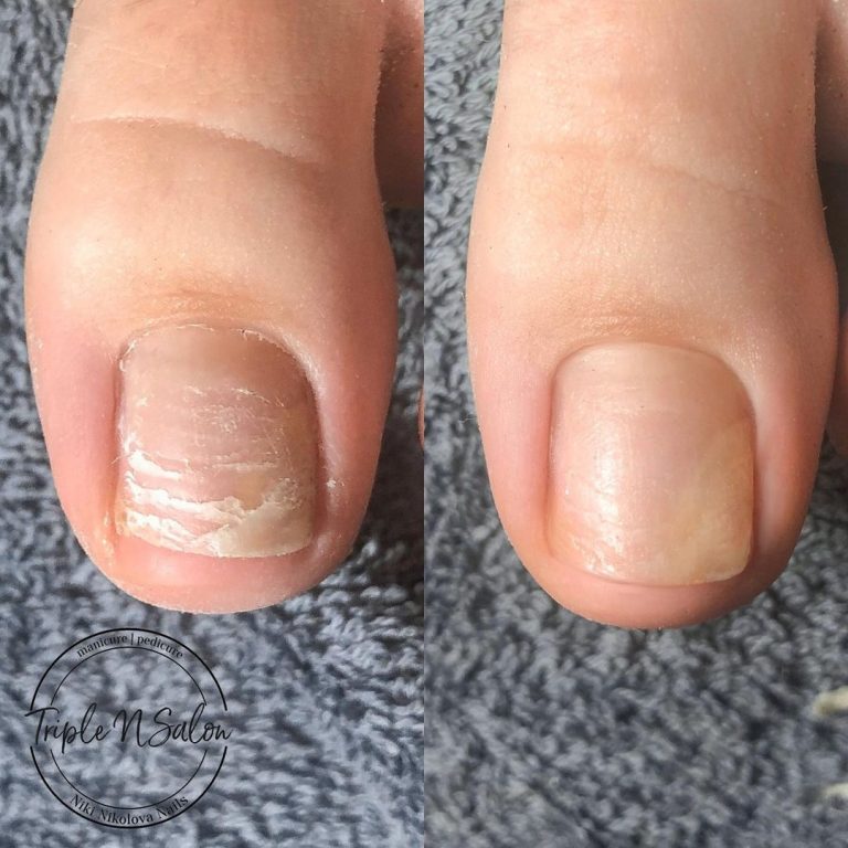 How To Fix Weak Nails