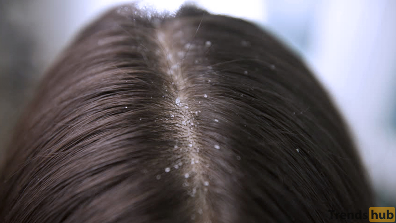 HOW TO GET RID OF DANDRUFF FAST