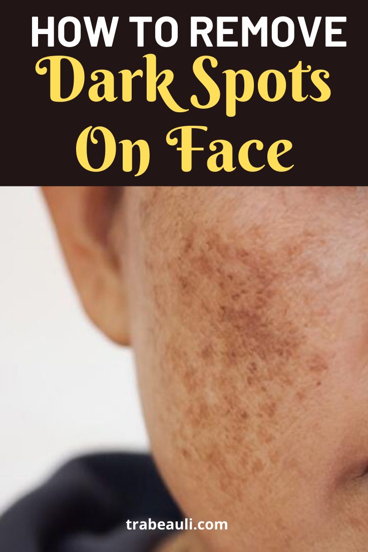 How To Get Rid Of Dark Spots Overnight With Home Remedies ...