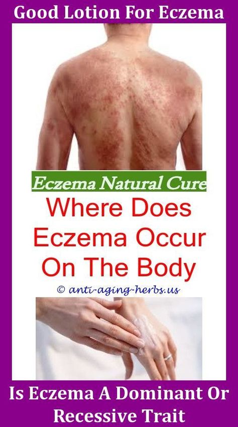 How To Get Rid Of Eczema On My Hands,narrow band uvb light ...