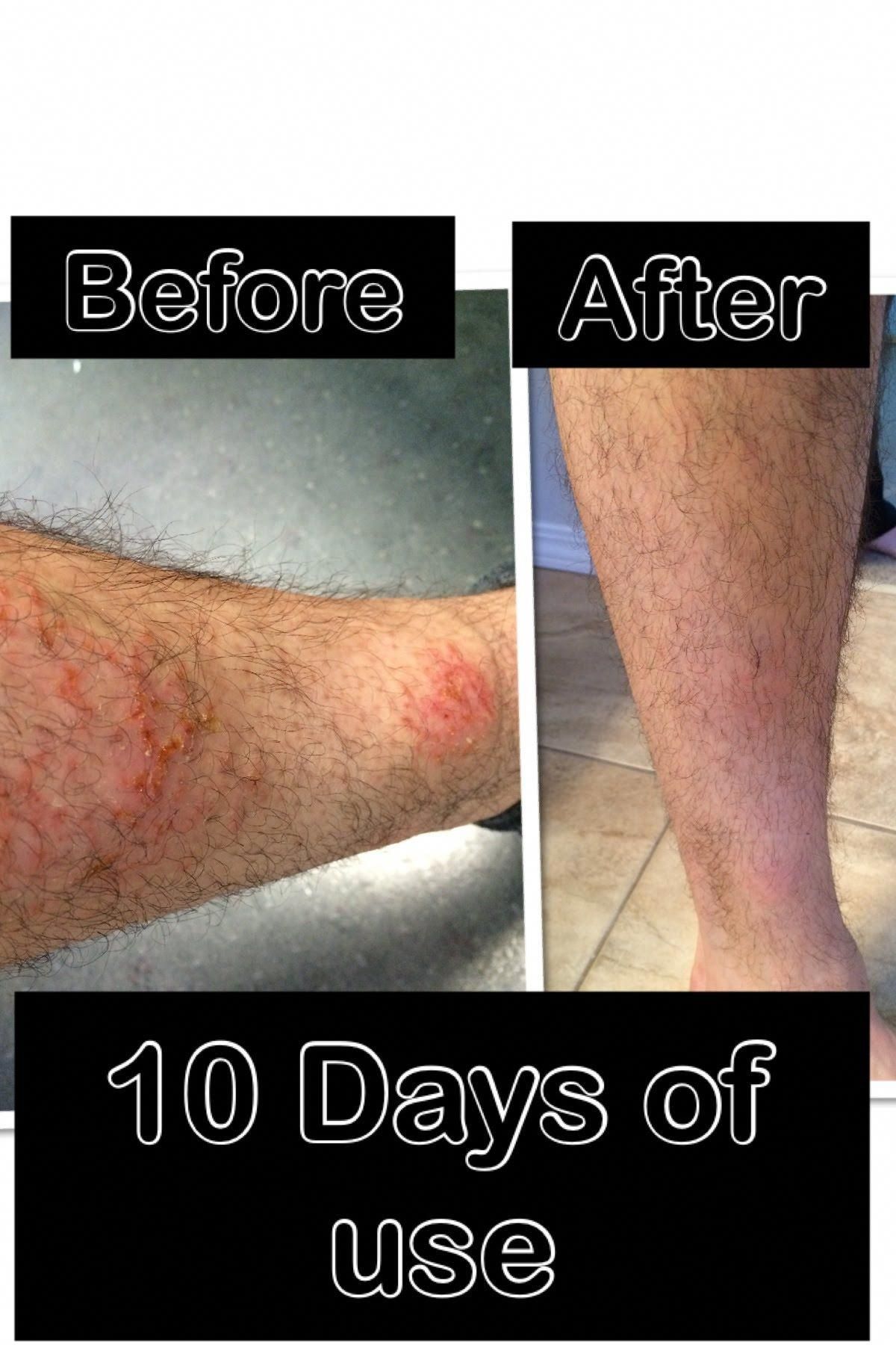 How To Get Rid Of Eczema Scars On Legs