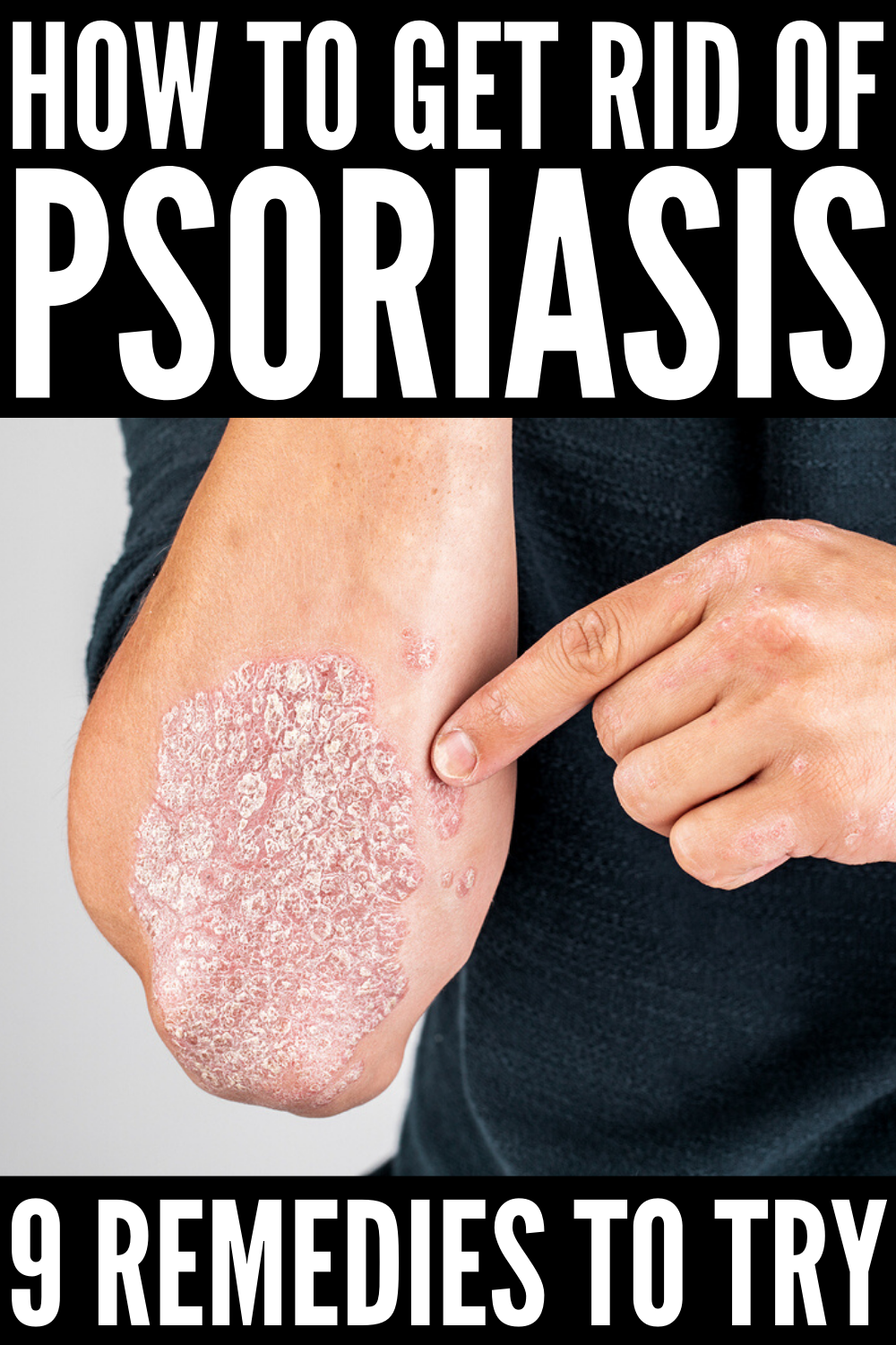 How to Get Rid of Psoriasis: 9 Tips and Remedies to Try in 2020 ...