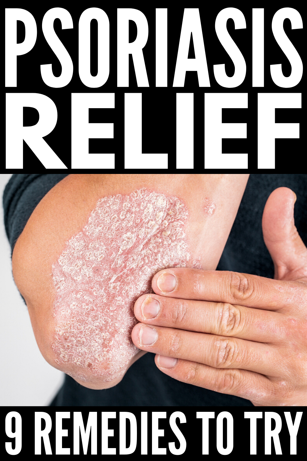 How to Get Rid of Psoriasis: 9 Tips and Remedies to Try in ...