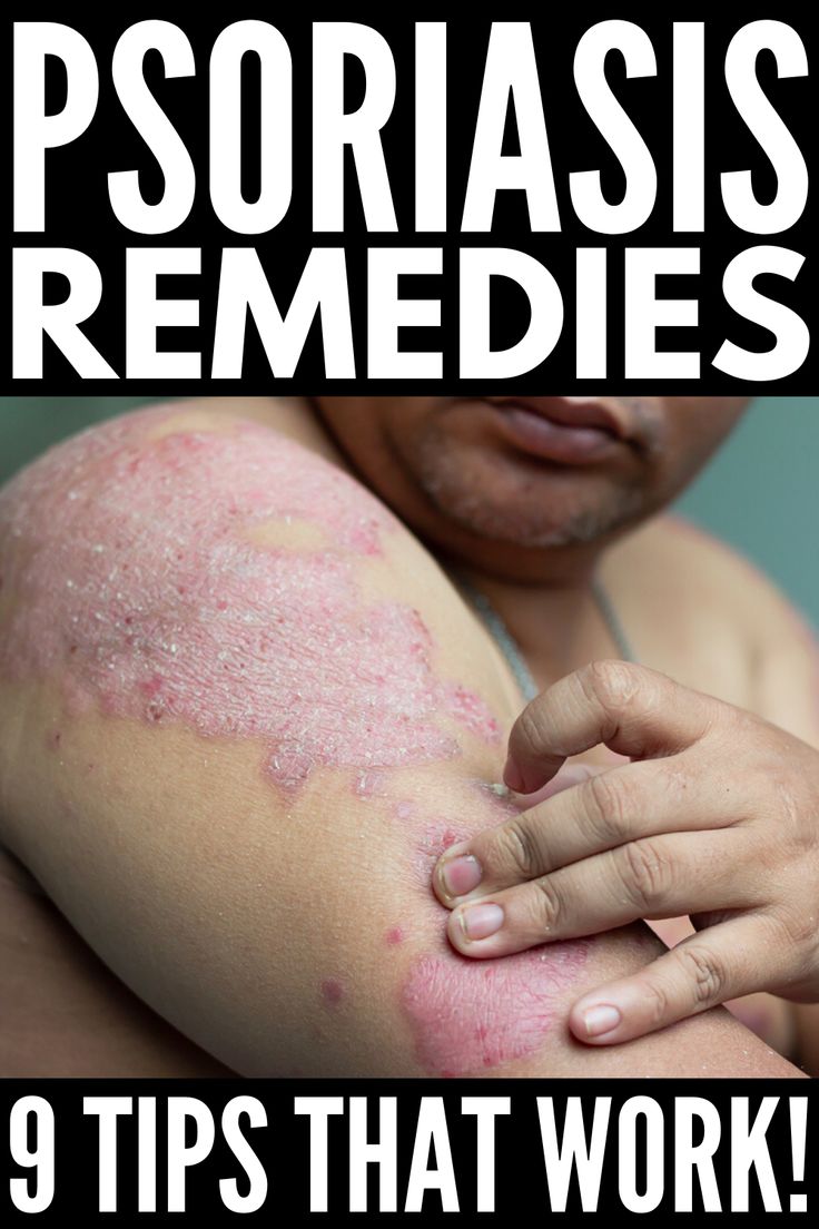 How to Get Rid of Psoriasis: 9 Tips and Remedies to Try