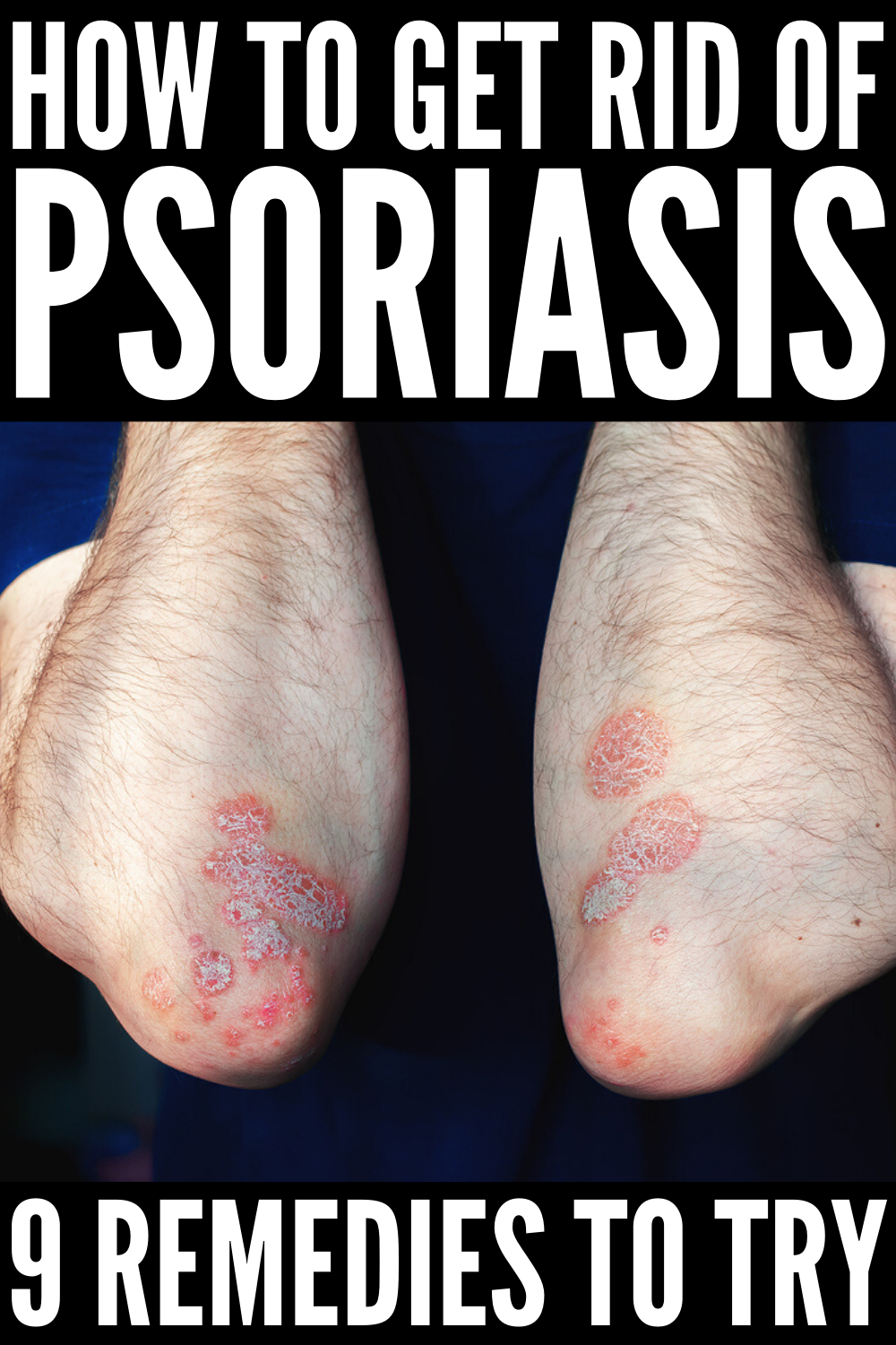 How to Get Rid of Psoriasis: 9 Tips and Remedies to Try