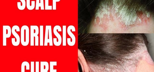 How To Get Rid Of Psoriasis In Your Scalp