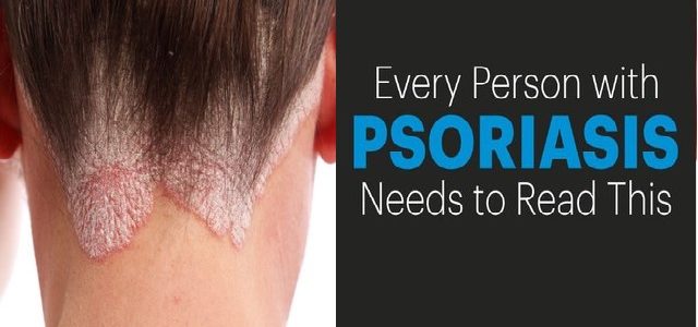 How To Get Rid Of Psoriasis On The Scalp Fast
