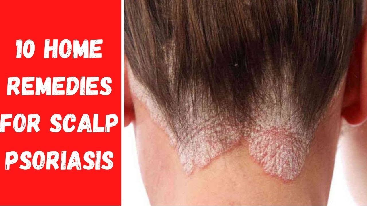 HOW TO GET RID OF PSORIASIS ON THE SCALP NATURALLY?