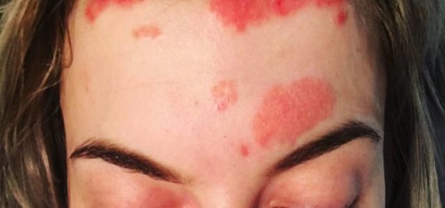 How To Get Rid Of Psoriasis On Your Face