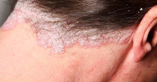 How to get rid of psoriasis on your scalp