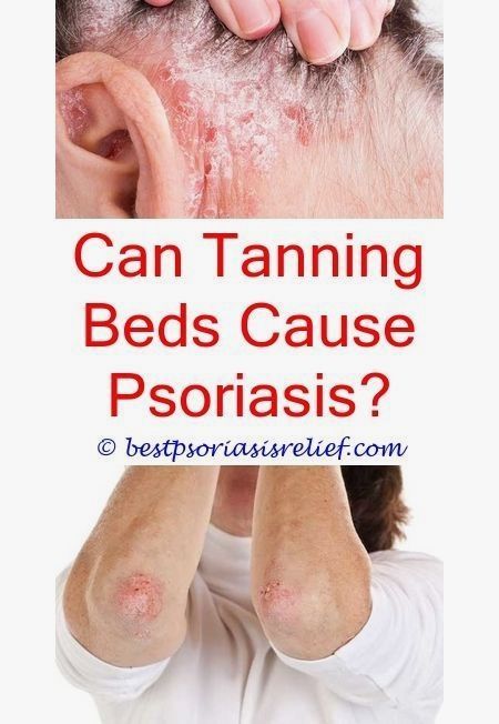 How To Get Rid Of Psoriasis Quickly