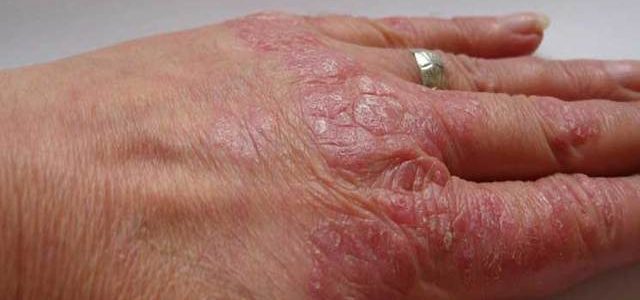 How To Get Rid Of Psoriasis Redness Fast