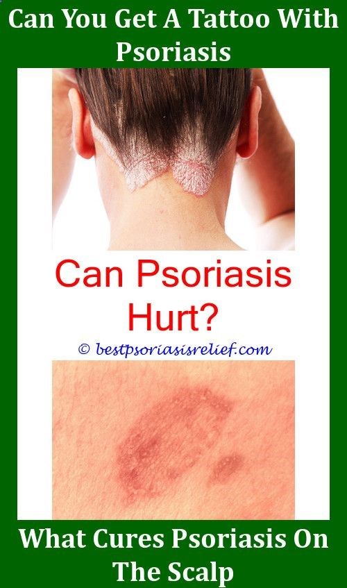 How To Get Rid Of Psoriasis Scales