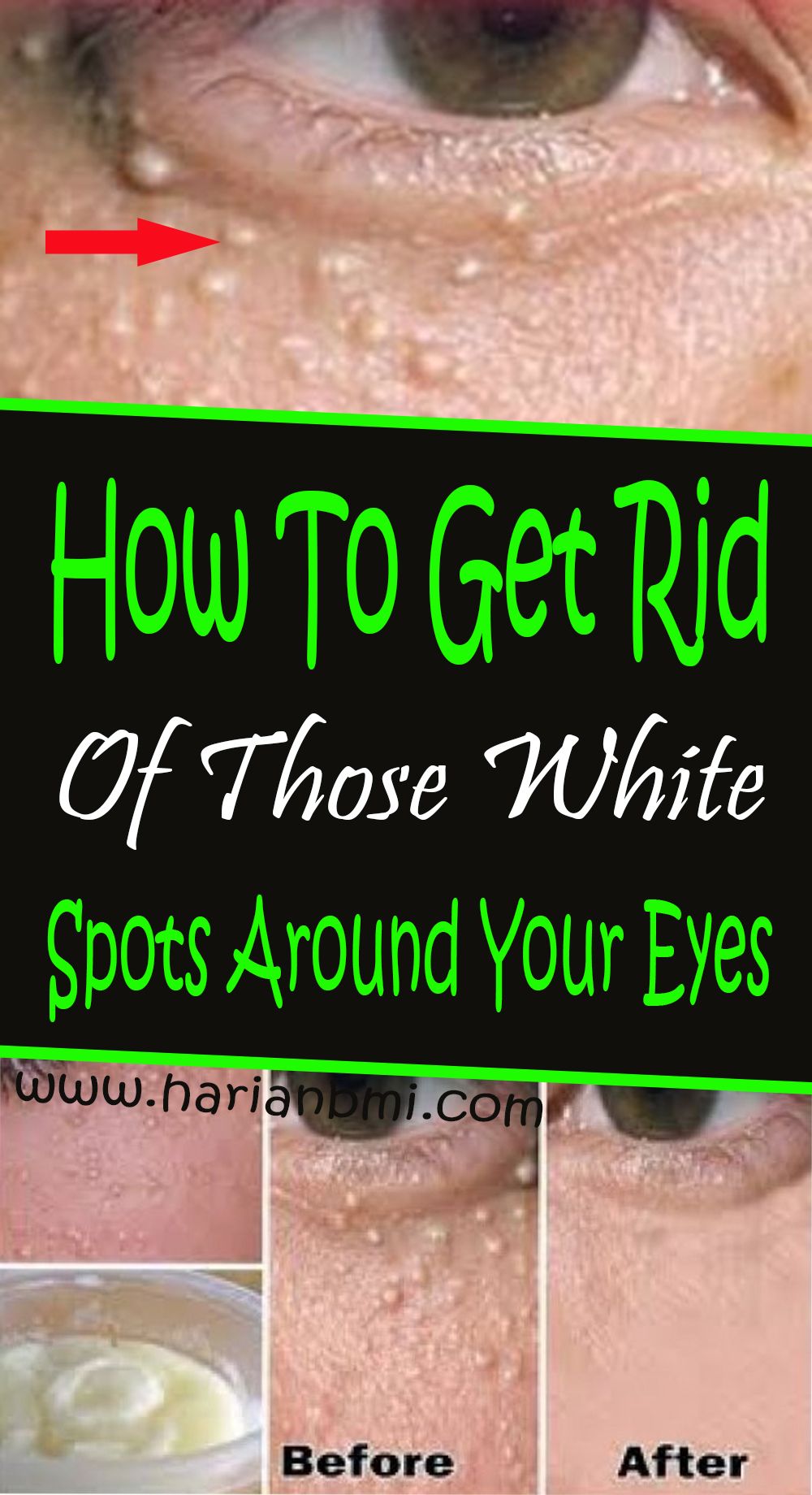 How To Get Rid Of Those White Spots Around Your Eyes # ...