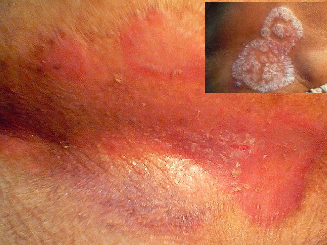 how to get rid psoriasis: PSORIASIS Painful skin disease.