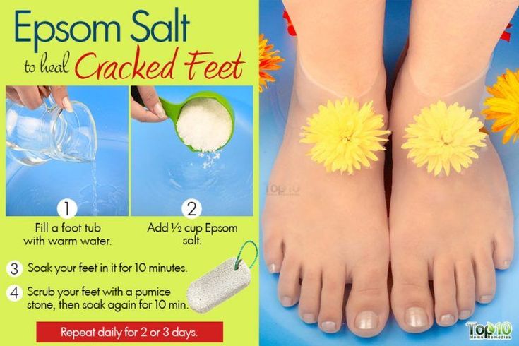How to Heal Cracked Feet