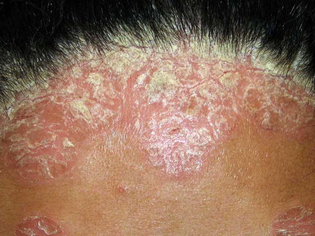 How to identify and treat scalp psoriasis