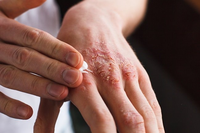 How to Identify and Understand Eczema