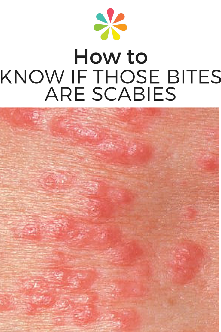 How to Know if That Rash Is Scabies