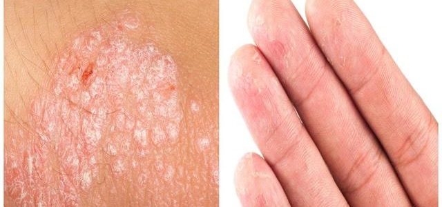 How To Know If You Have Psoriasis
