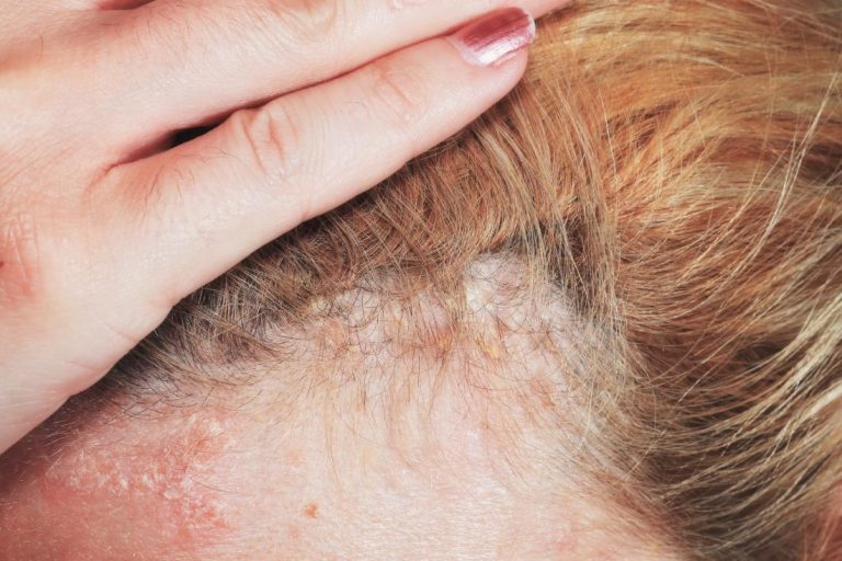 How to Know if You Have Psoriasis on Scalp ?