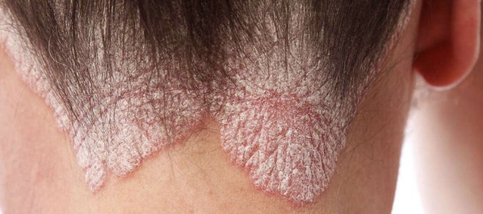 How To Loosen Psoriasis Scales On Scalp