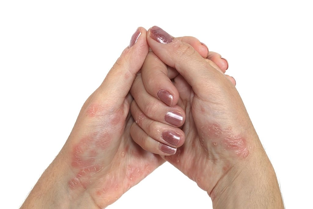 How To Manage Psoriasis Flare