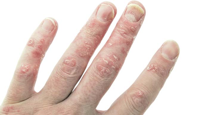 How To Prevent Psoriasis From Spreading?
