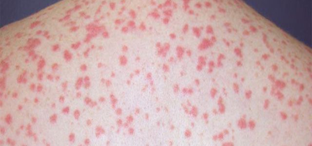How To Stop Guttate Psoriasis Spreading